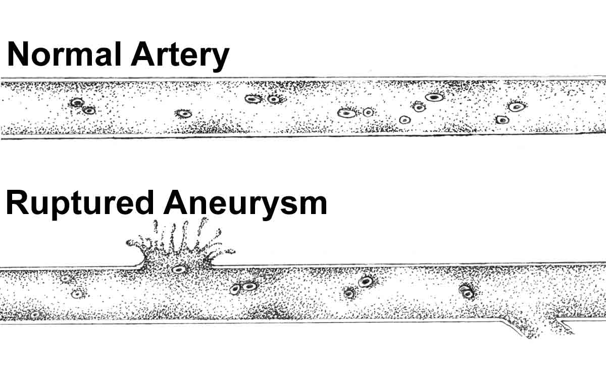 aneurysm