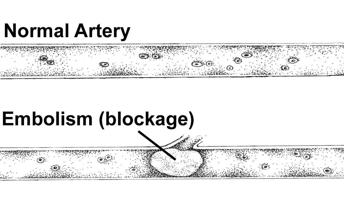 embolism