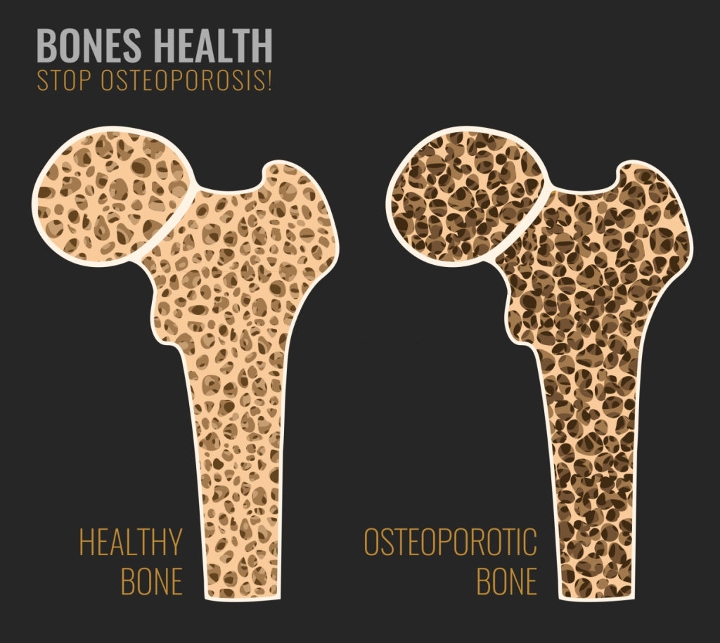 osteoporosis